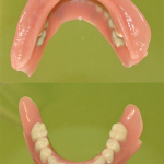 overdenture-su-impianti